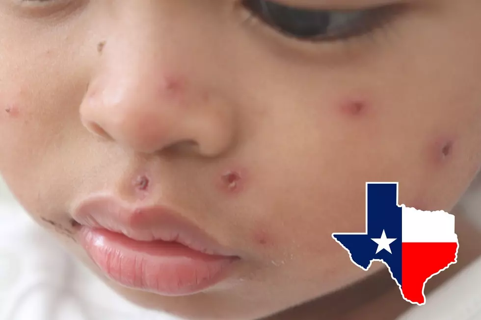 The Texas Measles Outbreak Now Officially The Worst In 30 Years